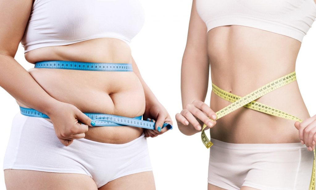 Aura Plastic Surgery Fat liposuction image