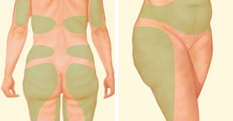 liposuction-before-back-thighs-stomach