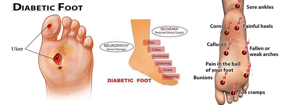 AuraPlastic Diabetic Foot Illustration