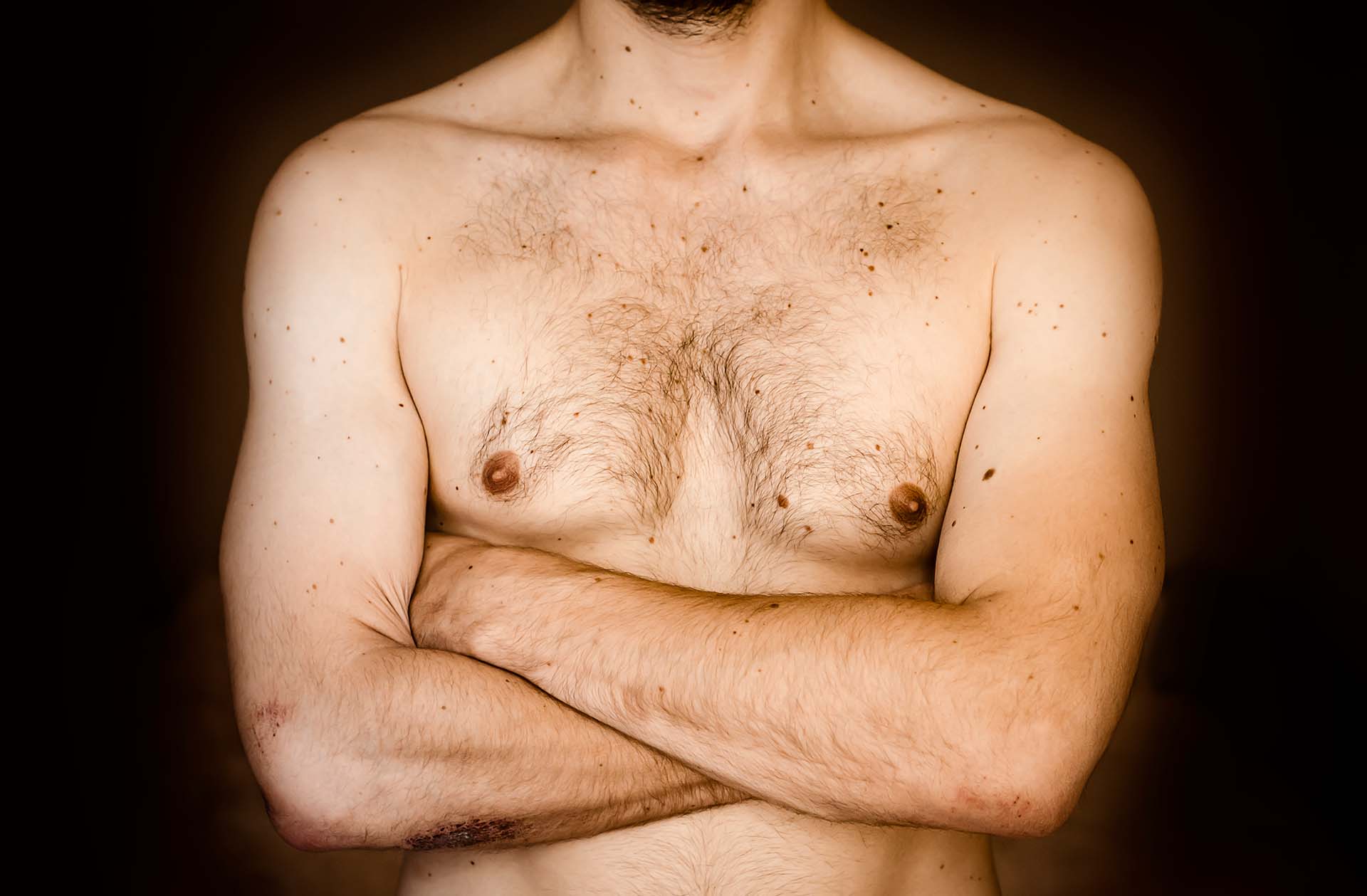 AURA PLASTIC SURGERY Male Breast Correction