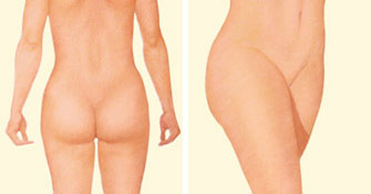 liposuction-after-buttock-thighs