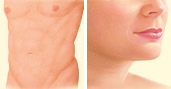 liposuction-after-stomach-breasts